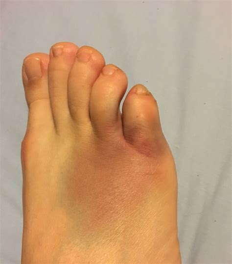 broken toe vs broken foot